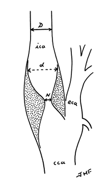 recommended method of measuring carotid stenosis