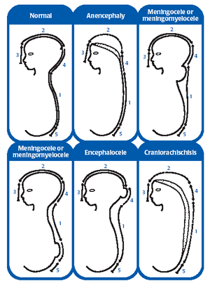 Figure 1. Selected NTDs from errors in multisite closure of the neural tube. Modified from Van Allen, Kalousek et al., 1993