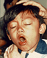 child with pertussis