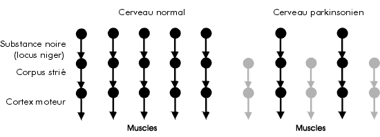 Différence entre un cerveau normal et un cerveau
			parkinsonien