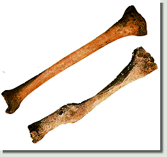 Tibia,that has healed from an injury